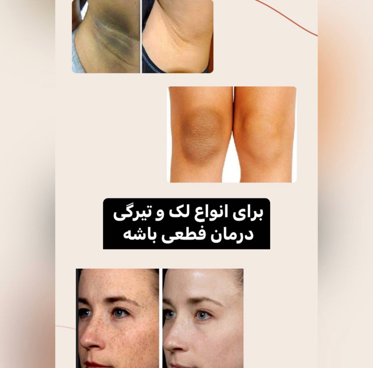 سرم روشن کننده و لایه بردار تخصصی صورت و بدن AHA